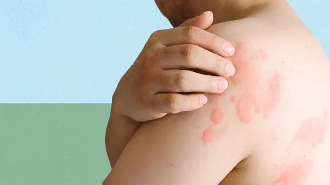 itching-and-hives-for-more-than-6-weeks-5-signs-it-could-be-chronic-spontaneous-urticaria